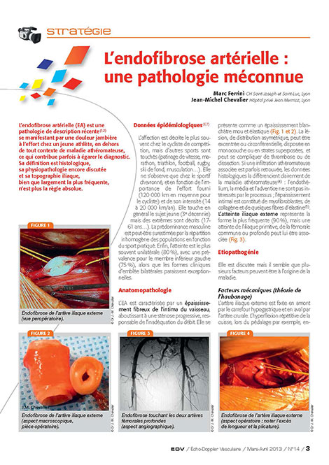 L’endofibrose artérielle : une pathologie méconnue